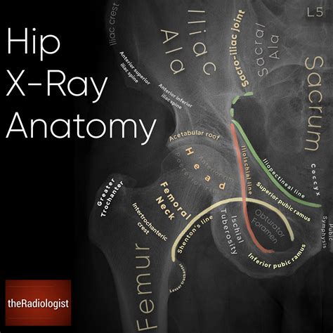 Labeled Hip X Ray Anatomy By Dr Naveen Sharma Theradiologist