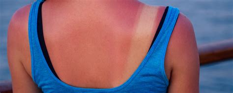 How To Treat Sunburn Fast 5 Things To Remember