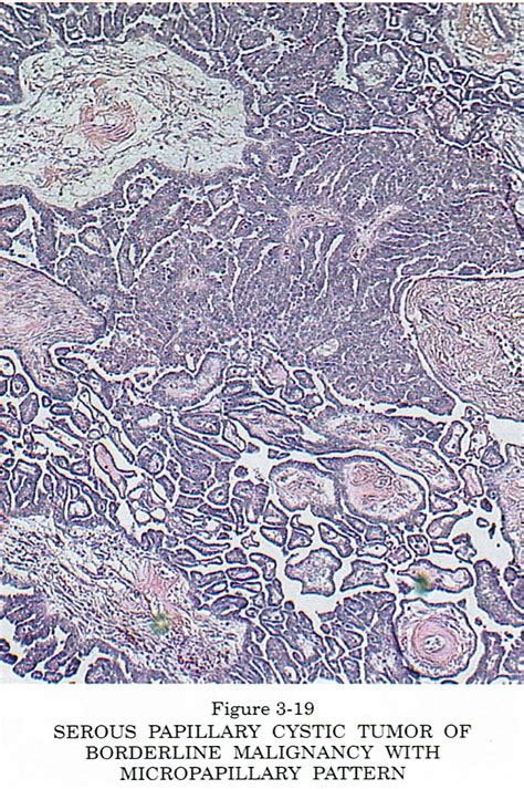 Pathology Outlines Serous Borderline Tumor Atypical Proliferative Serous Tumor