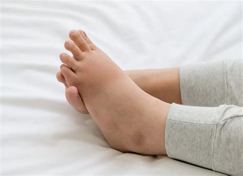 Swollen Foot During Pregnancy Podexpert