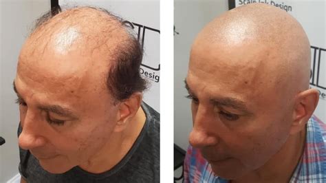 Scalp Micropigmentation For Men Receding Hairline And Balding