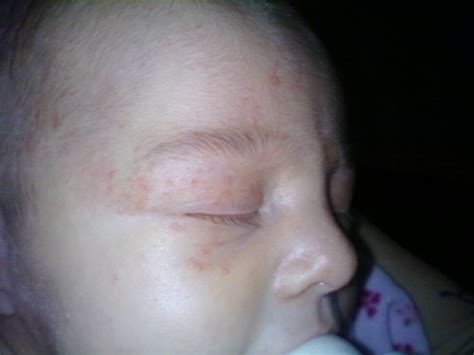 Lots Of Red Bumps On Babys Face Normal Pics Babycenter