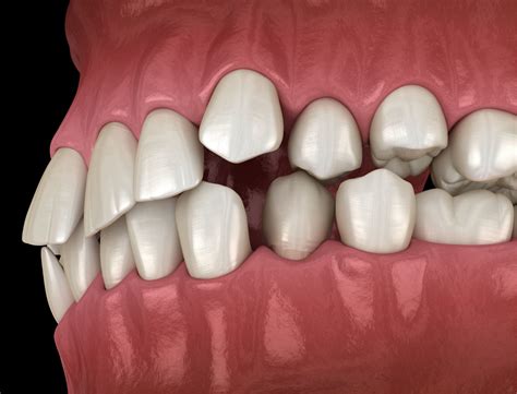 What Kinds Of Misalignments Can Braces Fix All Of These