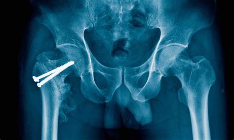 Fixation Hip By Screw X Ray Image Of X Ray Hip Fracture And Post Operation Hip Fixation By Screw