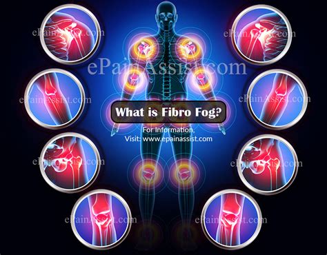 What Is Fibro Fogcausessignssymptoms