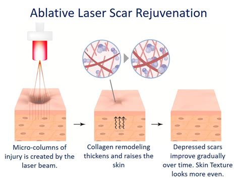 Acne Scar Removal Treatment A Complete Guide To Getting Clearer Skin