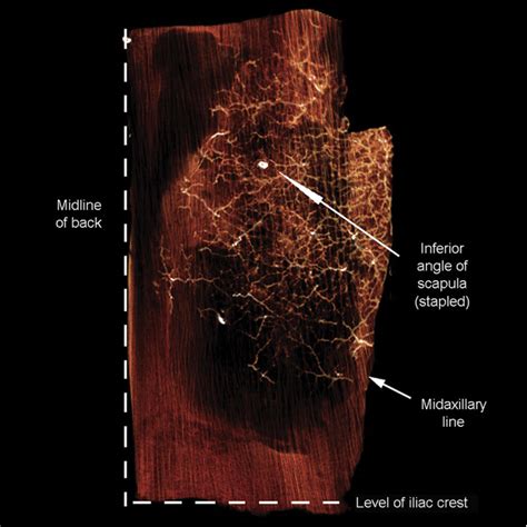 Figure 2 From Thoracodorsal Artery Perforator Flap And Latissimus Dorsi