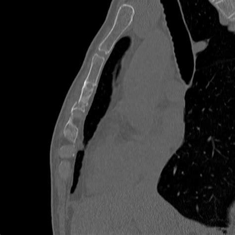 Sternum Fracture Radiology Case