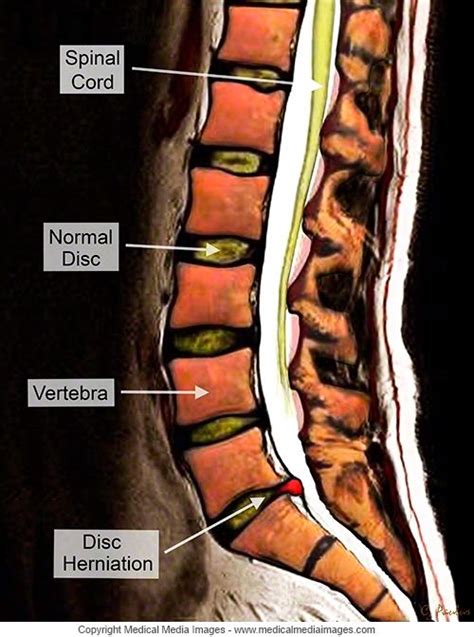 Color Mri Of The Lumbar Spine Low Back Showing A Disc Herniation In 3