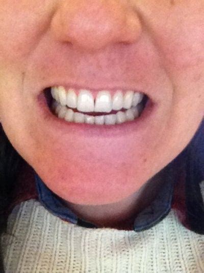 If your tooth is wobbly due to. I have a front loose tooth. Will I lose it? (photo ...