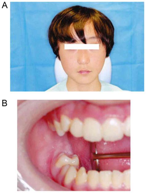 Calcifying Cystic Odontogenic Tumor Accompanied By A Dentigerous Cyst