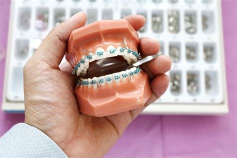 How To Care For Ceramic Braces Henry Orthodontics Pinehurst North Carolina