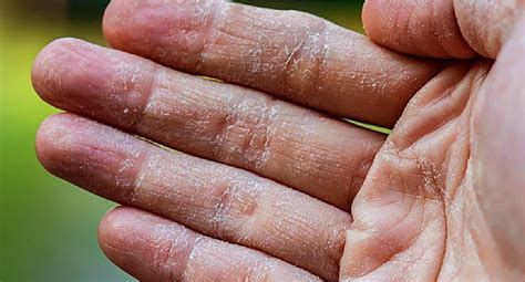 Eczema Inside Anus Dyshidrotic Peeling Skin Kind