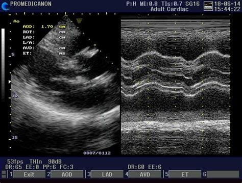 Aortic Valve Sclerosis B And M Mode Echocardiography Dr Paloma
