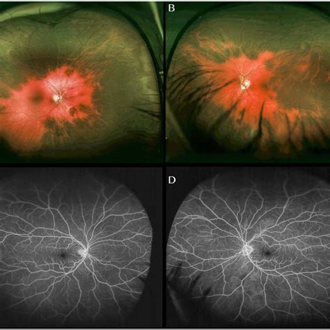 Ultra Wide Field Color Fundus Photograph Of The Right A And Left B