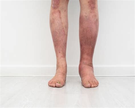 Skin Rash From Varicose Veins How To Treat And Reduce Itchiness Blog