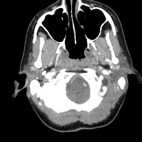 Normal Ct Of The Neck Radiology Case
