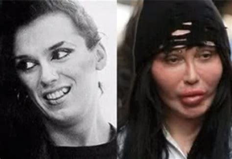 17 Celebrity Before And After Plastic Surgery Disasters Celebrity
