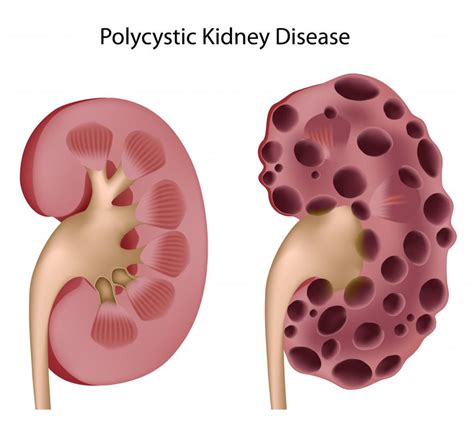 What Is An Enlarged Kidney With Pictures