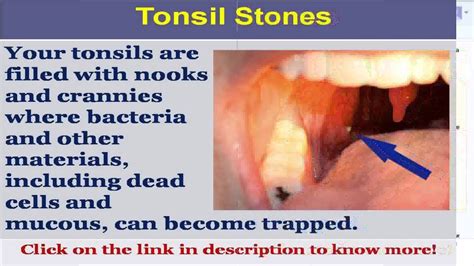 See Now Tonsil Stones Pics Youtube