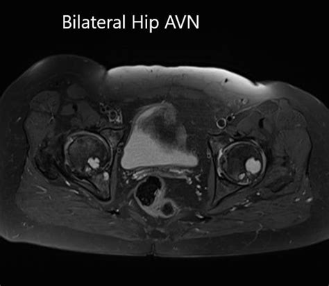 Case Study Bilateral Hip Management In 56 Year Old Female