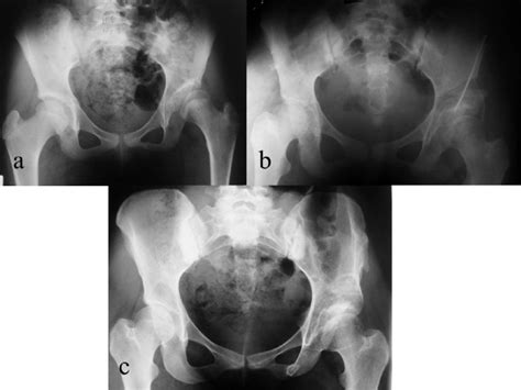 Anteroposterior Pelvic Radiograph Of A Female With Left Acetabular
