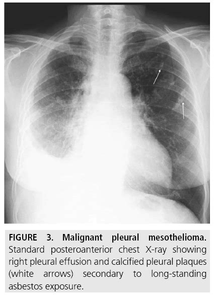 Diagnostic Imaging And Workup Of Malignant Pleural Mesothelioma