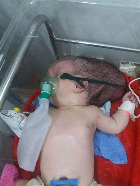 Baby Born With Half Her Skull Missing Defies The Odds To Survive Photos