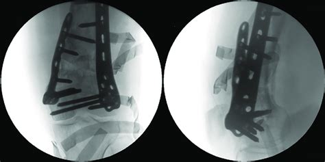 The Reconfirmation After Bilateral Plates Fixation The Osteotomy Gap