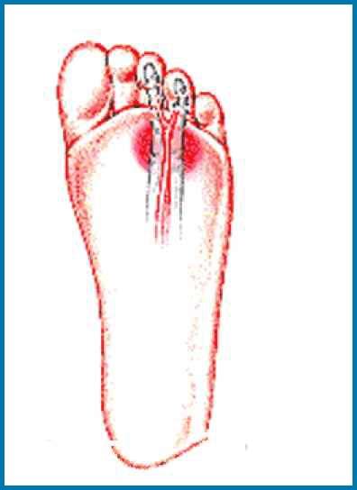 Mortons Neuroma Foot Health Podiatry Clinic
