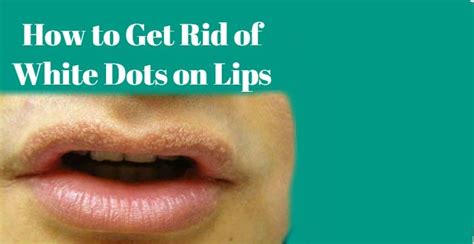 How To Get Rid Of White Dots On Lips Using Home Remedies