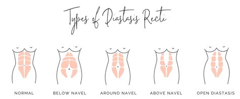 What You Need To Know About Diastasis Recti