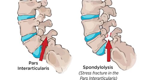 Understanding Spondylolysis Causes Symptoms And Treatments Reliefly