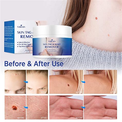 Skin Tag Remover Warts Mole Remover Cream Best Skin Tag Removal