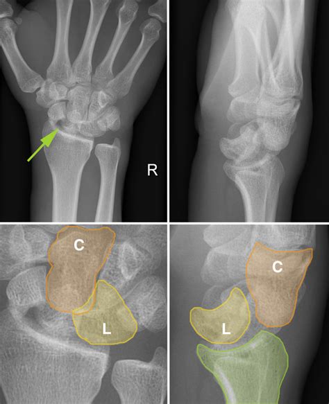 Perilunate Dislocation Radiology At St Vincents University Hospital