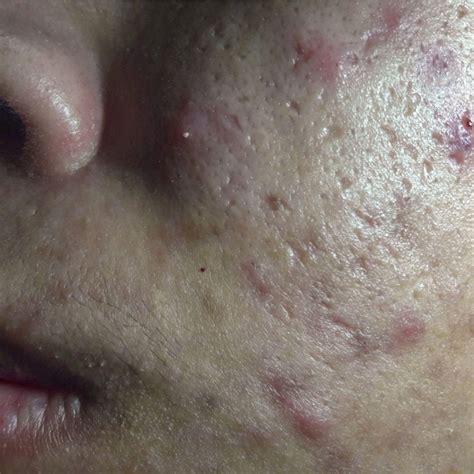 Acne Scarring Craig Singer Md Dermatology
