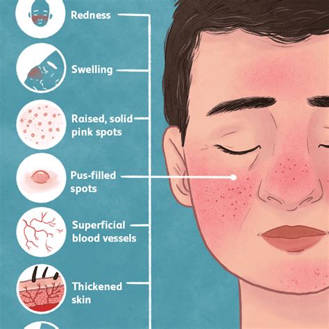 Rosacea — Know It All All You Need To Know About Rosacea By Clipo