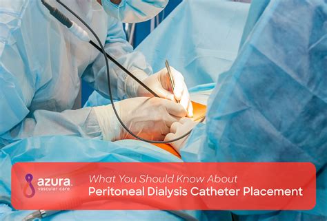 What To Know About Peritoneal Dialysis Catheter Placement