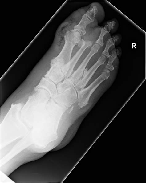 Charcot Arthropathy And Necrotizing Cellulitis Image