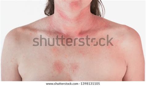 Allergic Skin Reaction On Female Neck Stock Photo Edit Now 1398131105