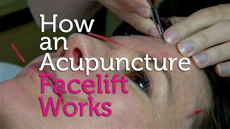 How An Acupuncture Facelift Works Youtube