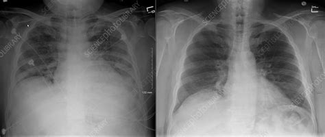 This image shows a normal chest. Normal Cheat Xray - Cheat Dumper