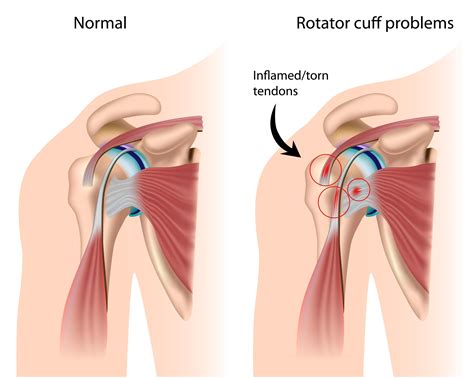Shoulder Impingement Physiotherapy Treatment Singapore Fast Pain