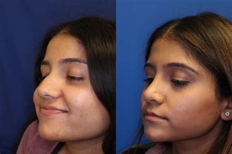 Nose Surgery Before And After Photos Patient 239 San Francisco Ca