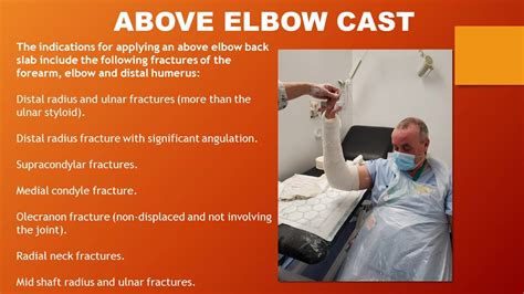 Above Elbow Cast