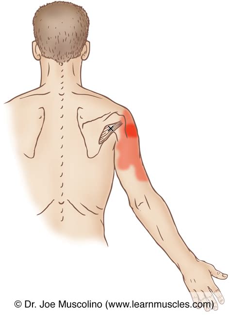Teres Minor Trigger Points Learn Muscles