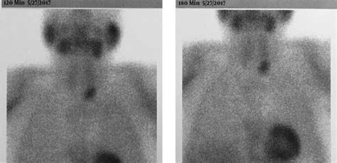 Recurrent Nephrolithiasis Leading To Renal Failure A Neglected Primary