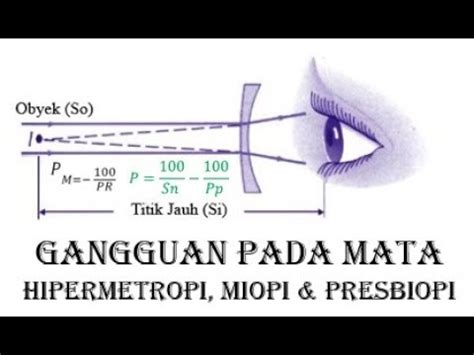 Gangguan Pada Mata Miopi Dan Hipermetropi YouTube