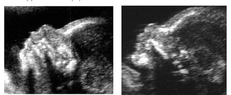 Pdf Sonographic Markers Of Fetal Aneuploidy A Review Semantic Scholar