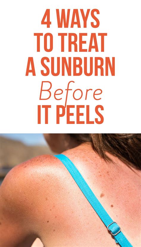 4 Ways To Treat A Sunburn Before It Peels So You Can Keep Your Tan
